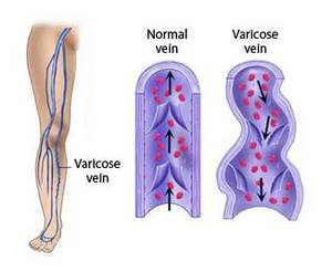 varicose veins during pregnancy prevention