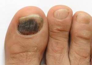 big toe injury blood under nail