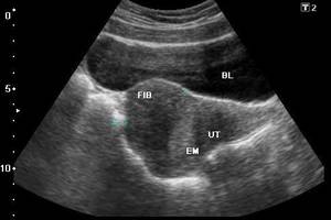 myoma uterine and pregnancy