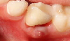 severe tooth pain under a crown