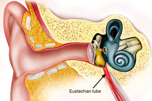 eustachian tube dysfunction symptoms