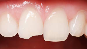 chipped tooth image