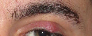 stye eyelid treatment