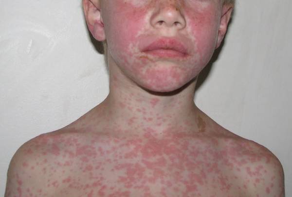 mononucleosis-amoxicillin-rash-https-www-amjmed-com-article-s0002