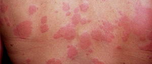 amoxicillin allergy rash treatment