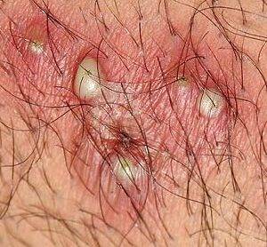 pictures of male genital herpes