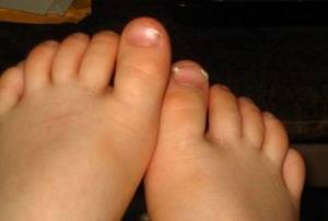 swollen feet during pregnancy images