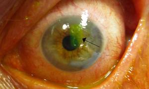 corneal abrasion after surgery