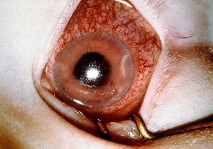 Acute Glaucoma Attack Treating