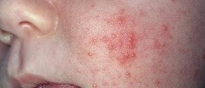 what can cause skin rash on face
