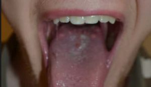 Main Causes Of Large Bumps On Back Of The Tongue IYTmed Com   92 Large Bumps Back Tongue Girl 300x173 