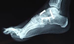 Foot Arthritis - Foot Gout - Toe Arthritis