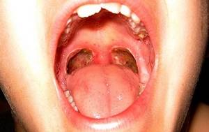 What are the symptoms of strep throat?