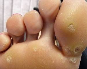 What are plantar warts