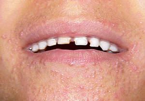 Periorificial dermatitis. How skin rash around mouth looks like