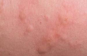 what causes rash between breast