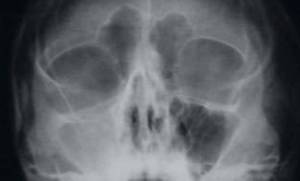 Antritis is an inflammation of the predominantly mucus membrane and the submucosal layer of the maxillary sinus (on image: x-ray of an antritis of the mucosa)