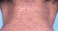 sarcoidosis skin: how does it looks like