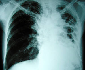 latent tuberculosis treatment options
