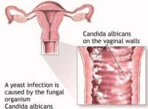 yeast infection after pregnancy