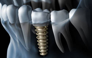 costs for dental implant abutment and crown