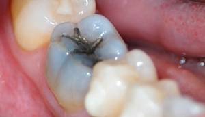 infection in gum after root canal