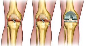 knee cartilage replacement surgery recovery