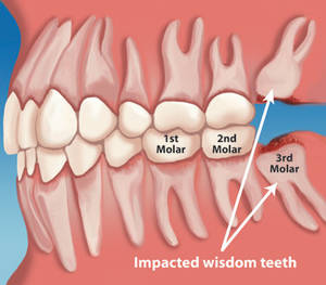 Wisdom Teeth Removal