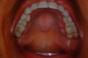 roof of mouth swollen on one side