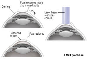 lasik eye surgery price 2016