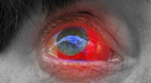 are burst blood vessels in the eye serious
