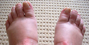 antibiotic side effects swollen feet