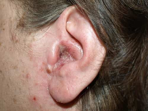 Otitis Interna: Causes, Symptoms and Treatment