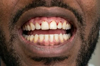 Close-up of a man's mouth showing early signs of gingivitis with slightly inflamed gums and a small spot of blood between the upper teeth.