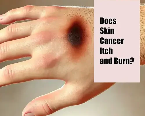 Does Skin Cancer Itch and Burn?