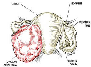 ovarian cancer