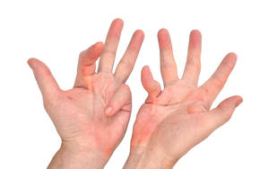 dupuytren's contracture images