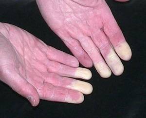 primary vs. secondary Raynaud