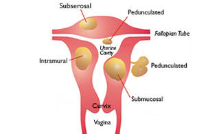 Can fibroid removed during pregnancy? While some research studies recommend uterine fibroids to pose hazard for pregnancy in the first trimester, others recommend that chances of cesarean section increases with this.