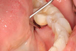 dental abscess pictures