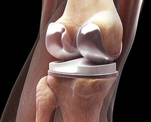 discomfort after knee replacement