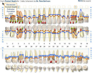 What Is Tooth Charting and Teeth Numbers Chart Meaning | IYTmed.com