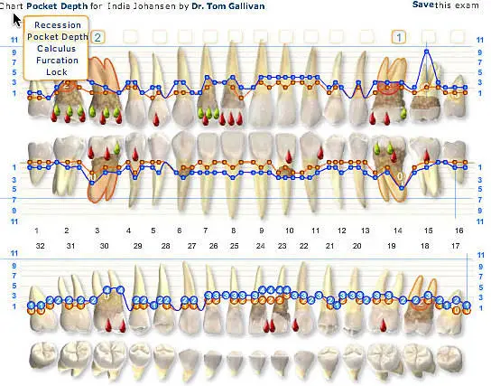 when referring to a tooth charting diagram