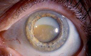 image of a cataract on eye