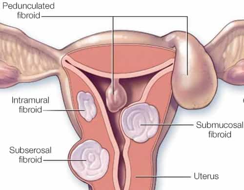 Fibroids need to be removed