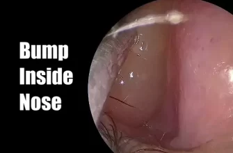 Bump Inside Nose