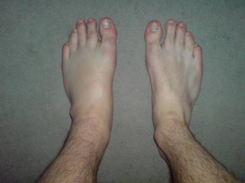 Causes Of Unexplained Swelling Of Left Foot And Ankle