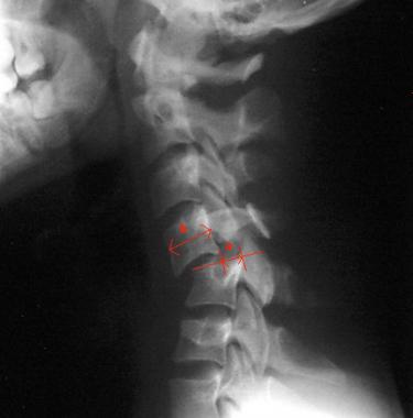 cervical spine fracture x ray