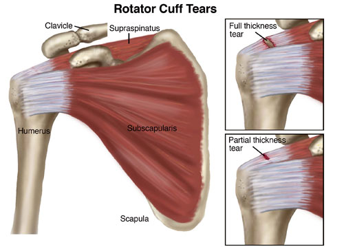 torn rotator cuff symptoms 