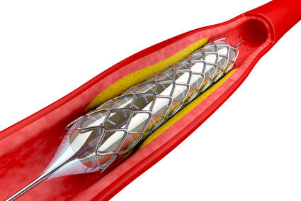 life after stent surgery